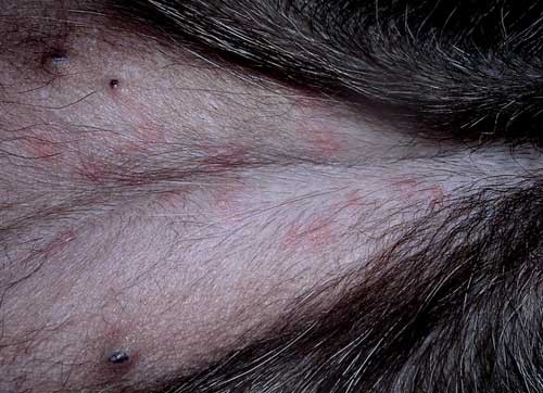 Juvenilni dermatits